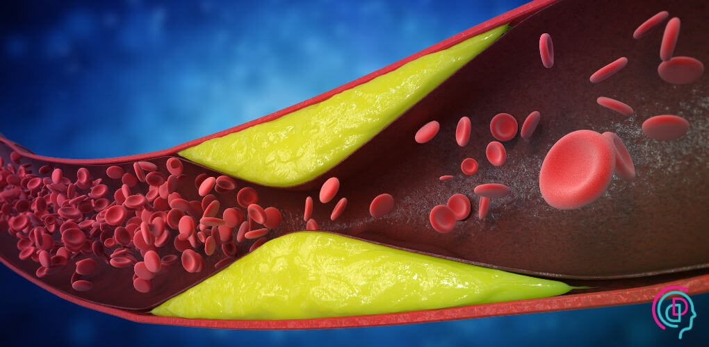 An artery demonstrating the relationship between inflammation instead of cholesterol levels and heart health.