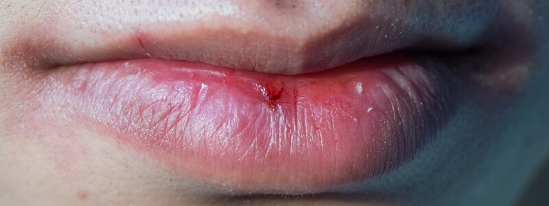 Illustration of common lip health issues like dryness and cracking