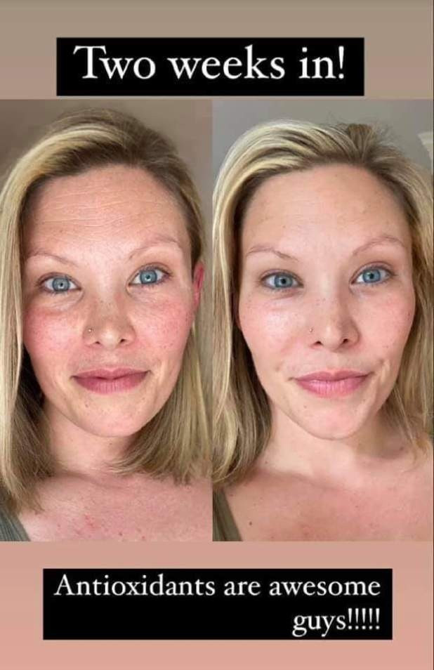 A friend's Boho Botox results